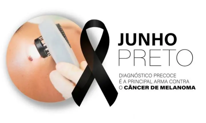 Diagnóstico precoce é a principal arma contra o melanoma, tipo mais agressivo de câncer de pele
